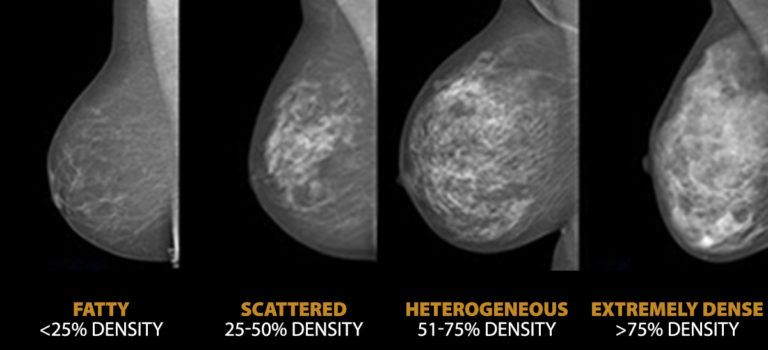 Breast Density: Does it really matter?