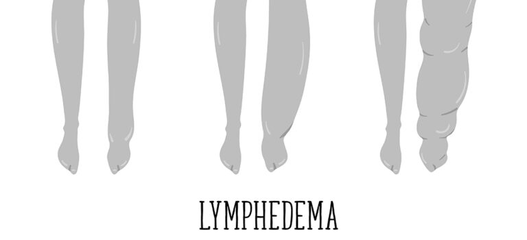 One Woman’s Lymphedema Diagnosis